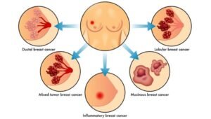 breast cancer