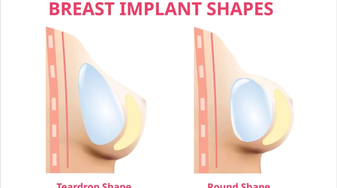 Shaped Implants vs Round in Breast Surgery
