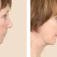 Smooth Chin Surgery Recovery