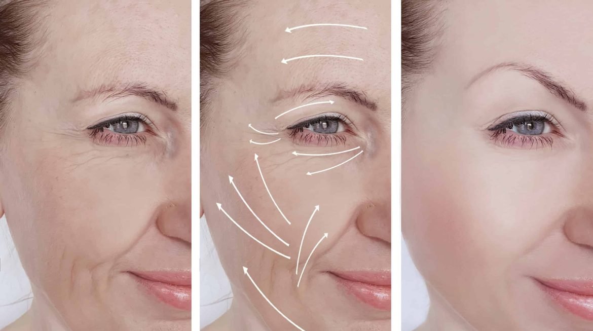 What is Short Scar Face Lift?