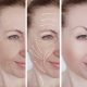 What is Short Scar Face Lift?