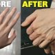 How is Veiny Hands Aesthetic Performed?