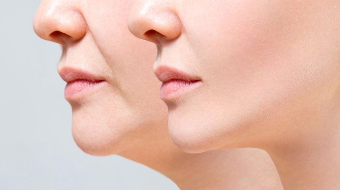 Sculpted Beauty Chin Liposuction Explained