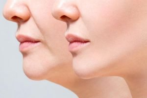 Sculpted Beauty Chin Liposuction Explained