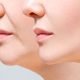 Sculpted Beauty Chin Liposuction Explained