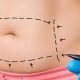 Transformative Tummy Tuck Before and After