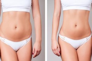 What Does Look Like Mommy Makeover Before and After?