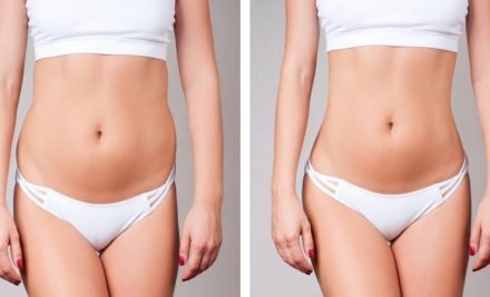 What Does Look Like Mommy Makeover Before and After?